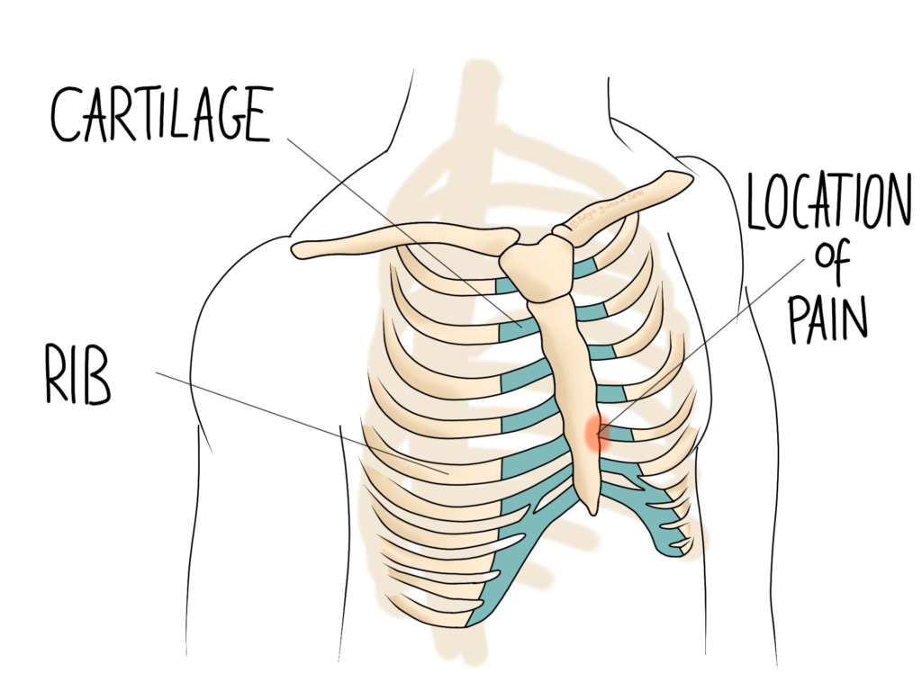 Chest rib origin of complaint