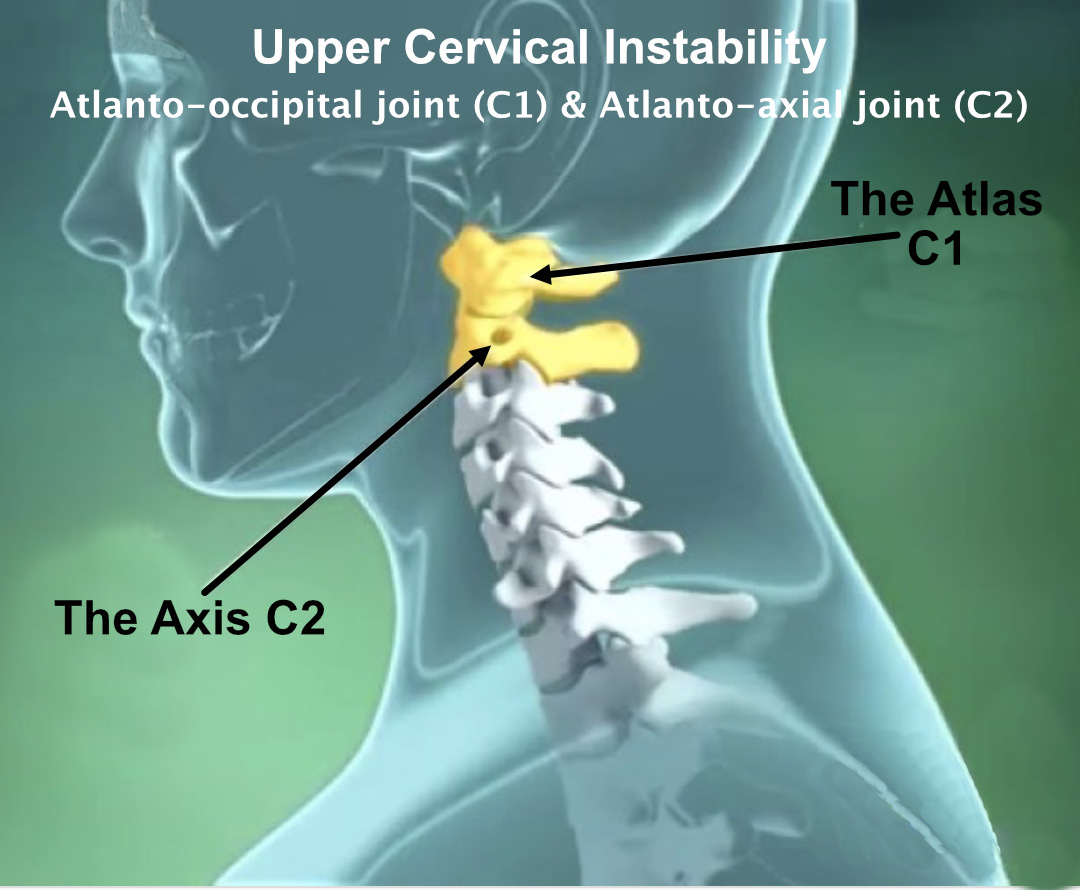 Headaches, Anxiety, Neck pain, Shoulder pain, Low Back pain all are directly attached to this area of the spine. Get checked by an experienced Chiropractic practitioner with this area of your spine as many practitioners are very inexperienced with this region of your body and will ignore this area while treating.